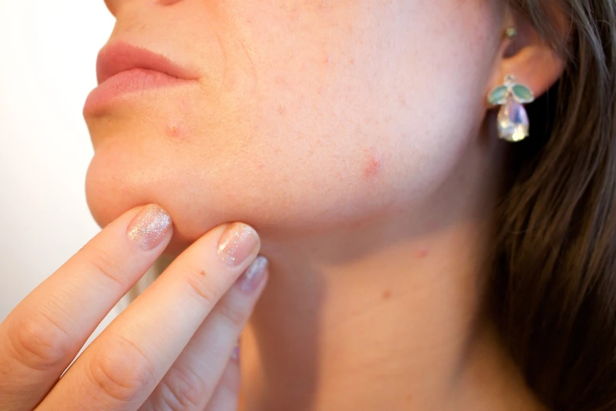 Close-up of woman with pimples